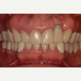 35-44 year old woman treated with Dental Implants before 3104335