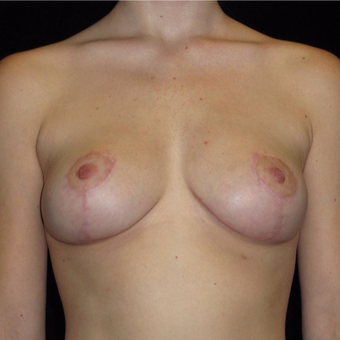 20 year old woman treated with Breast Lift after 3123435