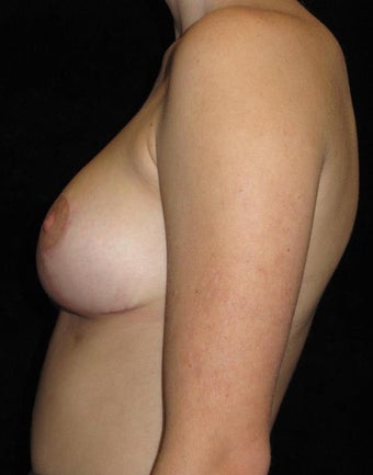 20 year old woman treated with Breast Lift 3123435