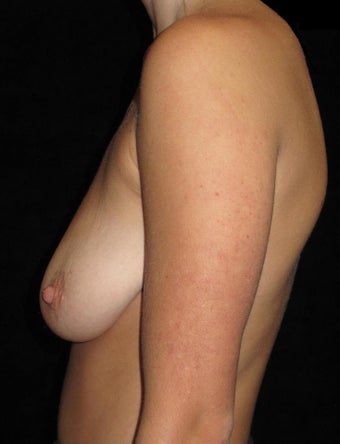 20 year old woman treated with Breast Lift 3123435