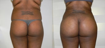 Body Sculpting with a Brazilian Butt Lift before 945822