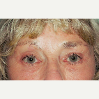 Eyelid Surgery (Blepharoplasty) after 3831648