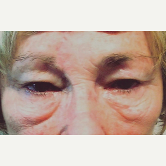 Eyelid Surgery (Blepharoplasty) before 3831648