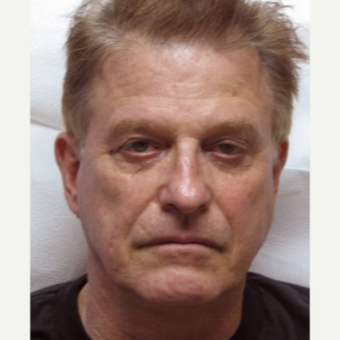 55-64 year old man treated with Thread Lift and Sculptra before 3243297