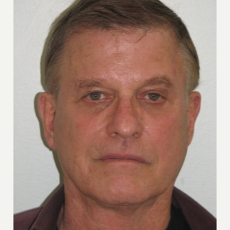 55-64 year old man treated with Thread Lift and Sculptra after 3243297