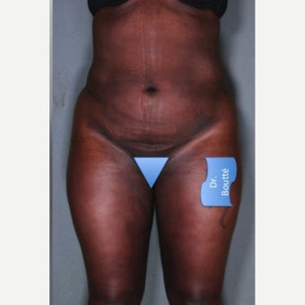 25-34 year old woman treated with Smart Lipo after 1651799