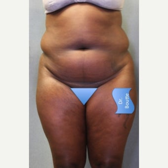 25-34 year old woman treated with Smart Lipo before 1651799