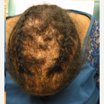 35-44 year old woman treated with PRP for Hair Loss after 3195441