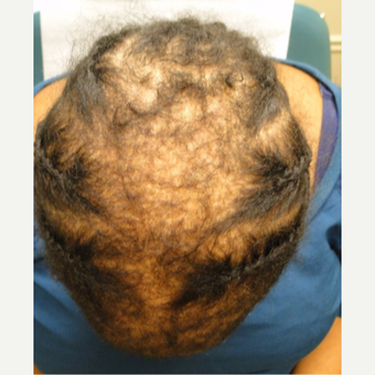 35-44 year old woman treated with PRP for Hair Loss before 3195441