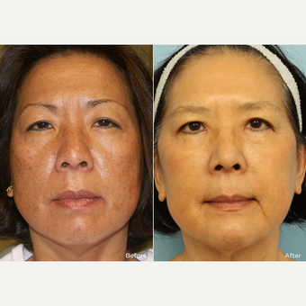 55-64 year old woman treated with IPL Photo Rejuvenation before 3241621