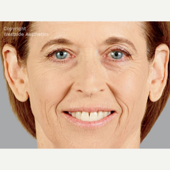 Voluma for Face/Cheeks after 3065358