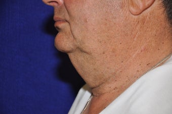 Necklift before 652581