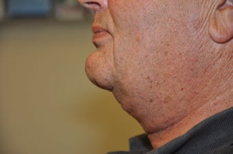 Necklift after 652581