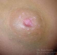 18-24 year old woman treated with Nipple Surgery after 1710134