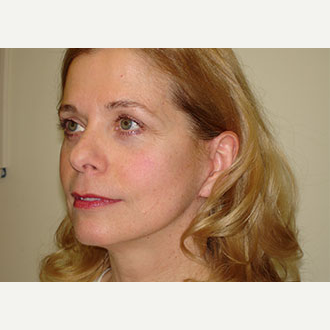 55-64 year old woman treated with Mini Lift and lower Lid Blepharoplasty. after 3264708