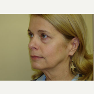 55-64 year old woman treated with Mini Lift and lower Lid Blepharoplasty. before 3264708
