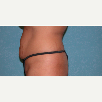 45-54 year old woman treated with Tummy Tuck before 3732099