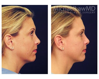 Chin Liposuction before 1256357