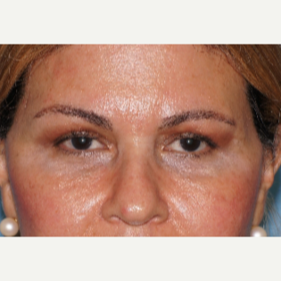 55-64 year old woman treated with Injectable Fillers around the brows and tear troughs after 3060596