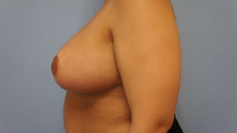 23 Year Old Female Breast Reduction and Nipple Graft Patient 1208873