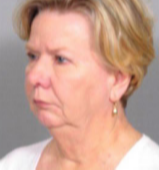 65 year old woman treated with Facelift before 3282916