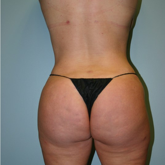 Brazilian Butt Lift after 3667592