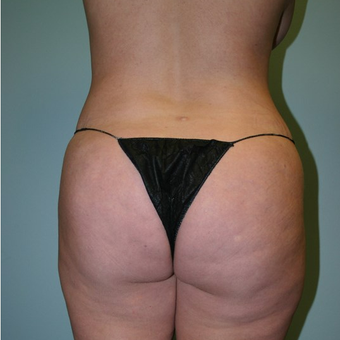 Brazilian Butt Lift before 3667592