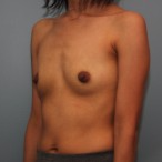 26 year old woman had Breast Augmentation with Silicone Implants before 3544162