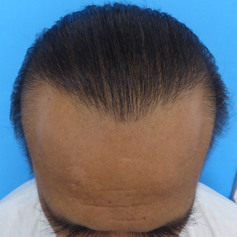 45-54 year old man treated with Hair Transplant after 3295454