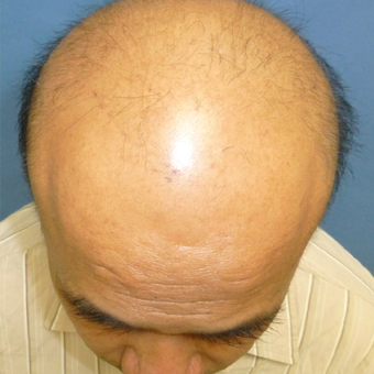 45-54 year old man treated with Hair Transplant before 3295454