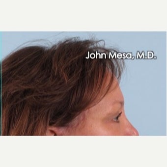 45-54 year old woman treated with Eye Bags Treatment after 2480885