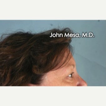 45-54 year old woman treated with Eye Bags Treatment before 2480885