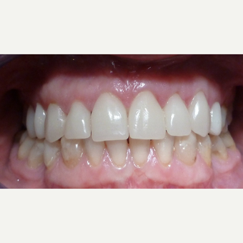 Cerac Dental Crowns placed to replace lost tooth after 3093845