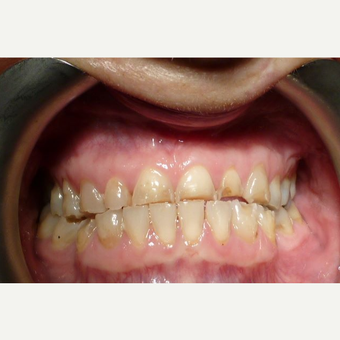 Cerac Dental Crowns placed to replace lost tooth before 3093845