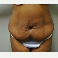 25-34 year old woman treated with Tumescent Liposuction & Abdominoplasty before 2276615