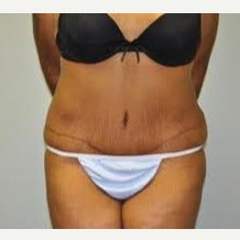 25-34 year old woman treated with Tumescent Liposuction & Abdominoplasty after 2276615