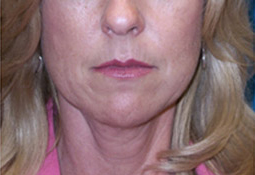50 Year Old Female Treated with Facelift for Jowls and Sagging Neck before 1081561