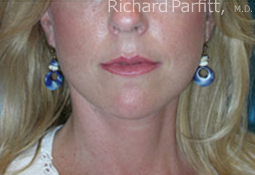 50 Year Old Female Treated with Facelift for Jowls and Sagging Neck after 1081561
