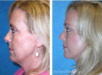50 Year Old Female Treated with Facelift for Jowls and Sagging Neck 1081561