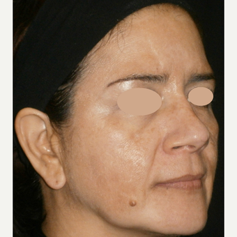 45-54 year old woman treated with Skin Lightening after 3140172