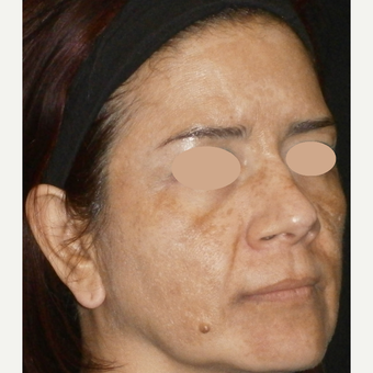45-54 year old woman treated with Skin Lightening before 3140172
