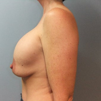 45-54 year old woman treated with Breast Implant Revision before 2141596