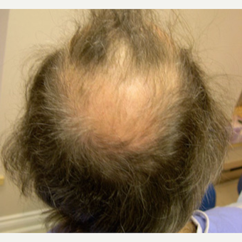 56 year old man treated with FUE Hair Transplant before 3608858