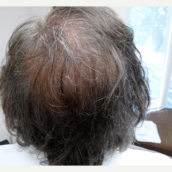 56 year old man treated with FUE Hair Transplant after 3608858