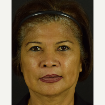 Facial Rejuvenation with Novathreads after 3645183