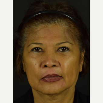 Facial Rejuvenation with Novathreads before 3645183