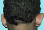Ear Surgery for Men before 973995