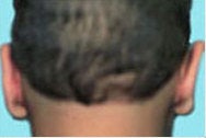 Ear Surgery for Men after 973995