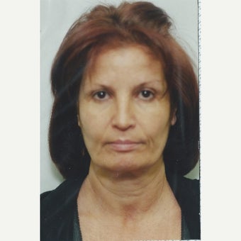 57 year old woman-Thread Lift before 1618563