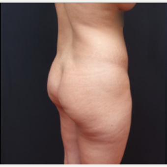 25-34 year old woman treated with Tumescent Liposuction before 3280020